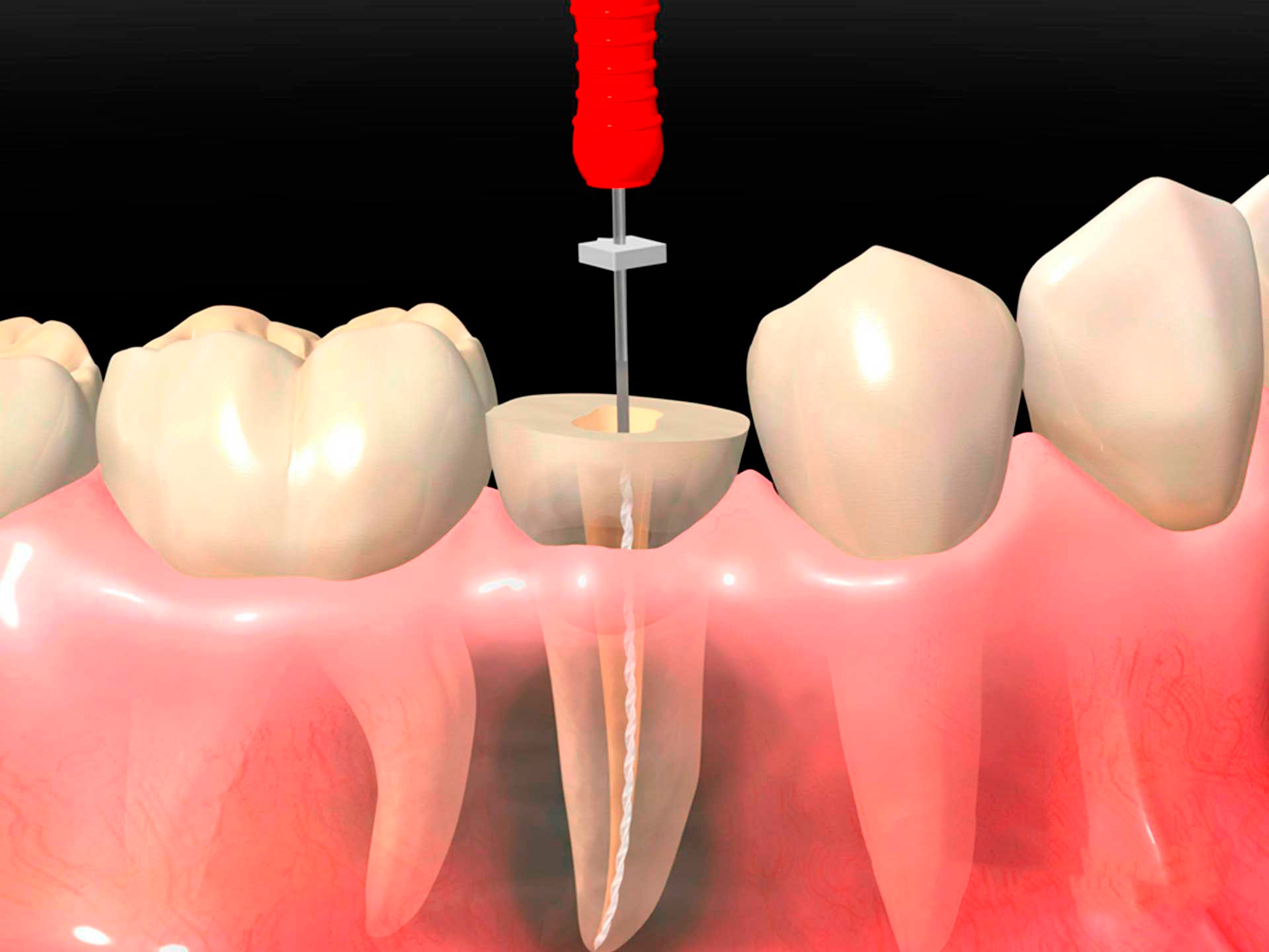 Endodoncia